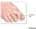 Hammer toe