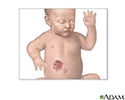Hemangioma excision