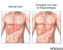 Hepatomegaly