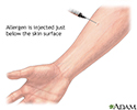 Aspergillus antigen skin test