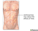 Hives treatment