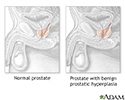 Hyperplasia