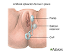 Inflatable artificial sphincter