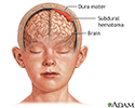 Subdural hematoma