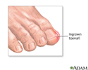 Ingrown toenail