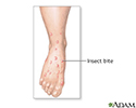 Insect bites and stings