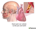 Jaw pain and heart attacks