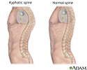 Kyphosis