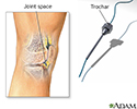 Synovial biopsy