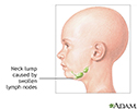 Neck lump