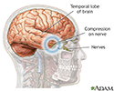 Brain herniation