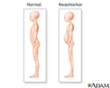 Kwashiorkor symptoms
