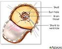 Craniotomy for cerebral shunt
