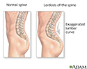 Lordosis
