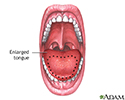 Macroglossia