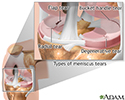 Meniscal tears