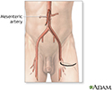 Mesenteric arteriography