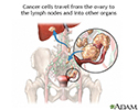Ovarian cancer metastasis