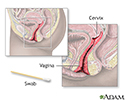 Pap smear
