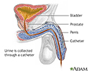 Catheterization