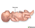 Neonate