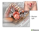 Ovarian cyst