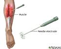Electromyography