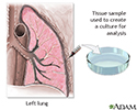 Pleural culture