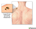 Melanoma