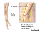 Radial nerve dysfunction