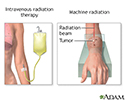 Radiation therapy