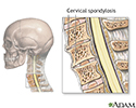 Cervical spondylosis