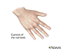 Cyanosis of the nail bed