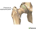 Femoral fracture