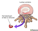 Herniated disk repair