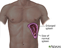 Enlarged spleen