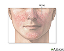 Acne