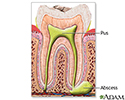 Tooth abscess