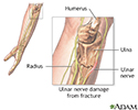 Ulnar nerve damage