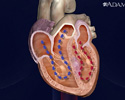 Cardiomyopathy