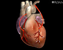 Heart bypass surgery