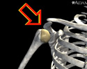 Shoulder joint dislocation