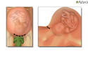 Cesarean section