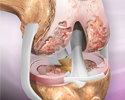 Arthritis
