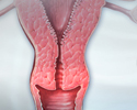 Cervical cancer