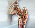 Osteoporosis
