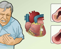 Angina causes and symptoms