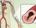 Atherosclerosis causes