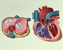 Valvular heart disease (VHD) overview