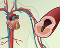 Cardiovascular disease - description